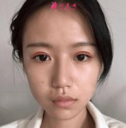 杭州華山連天美割雙眼皮價(jià)格收費(fèi)標(biāo)準(zhǔn)分享~含案例對比圖
