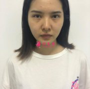 北京八大處隆鼻怎么樣？附隆鼻手術(shù)前后對比圖分享