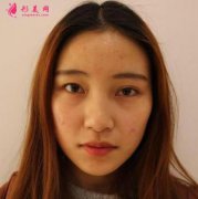 北京八大處雙眼皮多少錢(qián)？2021手術(shù)案例及全新價(jià)格表在線查詢