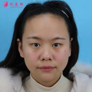 北京京民整形外科怎么樣？隆鼻多少錢(qián)？附案例