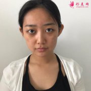 河南省中醫(yī)藥大學(xué)第一附屬醫(yī)院做雙眼皮怎么樣？附雙眼皮案例一覽