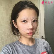 上海九院整形科隆鼻貴嗎？真實(shí)案例和價(jià)格表一起瞧瞧~