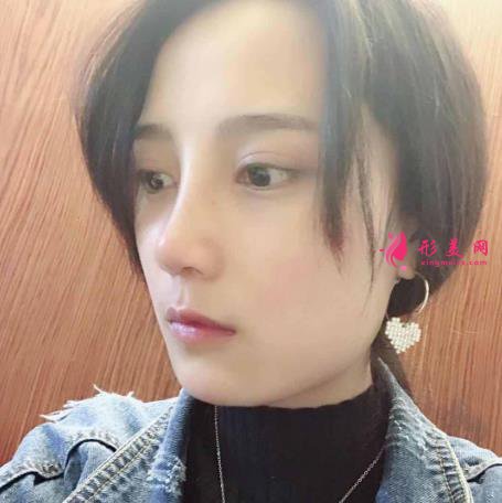 鄭州大學(xué)第一附屬醫(yī)院整形科怎么樣？隆鼻價(jià)格及恢復(fù)效果展示