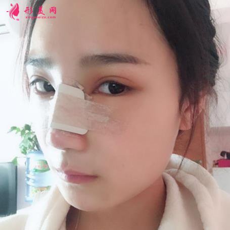 鄭州大學(xué)第一附屬醫(yī)院整形科怎么樣？隆鼻價(jià)格及恢復(fù)效果展示