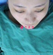 北京聯(lián)合麗格第一醫(yī)院雙眼皮案例分享！附2022價(jià)格表