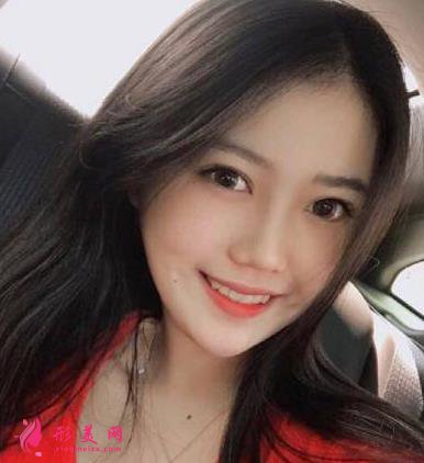 北京聯(lián)合麗格第一醫(yī)院雙眼皮案例分享！附2022價(jià)格表