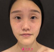 武漢同濟(jì)醫(yī)院整形科隆鼻怎么樣？附術(shù)后案例及價格表一覽~