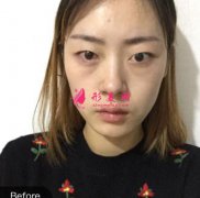 深圳富華醫(yī)院做眼綜合效果咋樣!術(shù)后案例對比+價格表一覽~