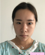 上海玫瑰醫(yī)療美容醫(yī)院怎么樣?雙眼皮案例分享