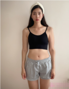 廣州紫馨整形外科醫(yī)院吸脂怎么樣？腰腹吸脂前后對(duì)比圖一覽