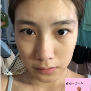 上海華美楊亞益醫(yī)生雙眼皮怎么樣？附雙眼皮術(shù)后案例分享