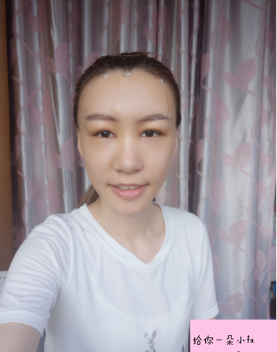 北京純脂馮斌脂肪填充怎么樣?看看術(shù)后效果怎么樣? 北京純脂馮斌脂肪填充怎么樣?看看術(shù)后效果怎么樣?