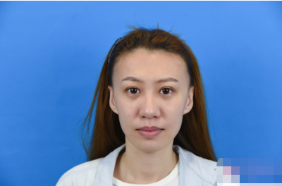 北京純脂馮斌脂肪填充怎么樣?看看術(shù)后效果怎么樣? 北京純脂馮斌脂肪填充怎么樣?看看術(shù)后效果怎么樣?