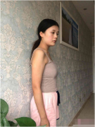 南京友誼整形外科醫(yī)院自體脂肪隆胸怎樣？隆胸前后對(duì)比圖分享一覽