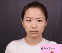 浙二醫(yī)院割雙眼皮好嗎?雙眼皮前后變化圖一覽