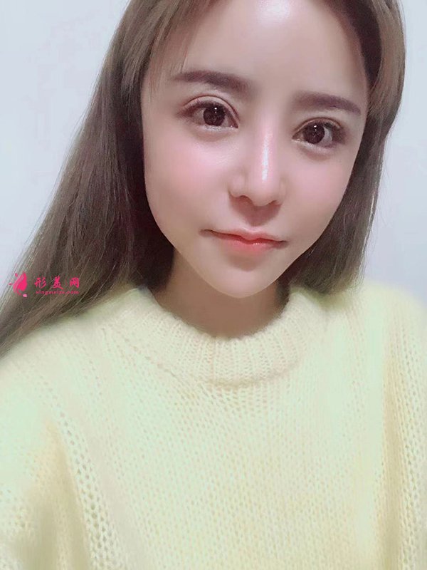 上海華美醫(yī)療美容醫(yī)院徐文龍醫(yī)生膨體隆鼻案例-整容案例 上海華美醫(yī)療美容醫(yī)院徐文龍醫(yī)生膨體隆鼻案例