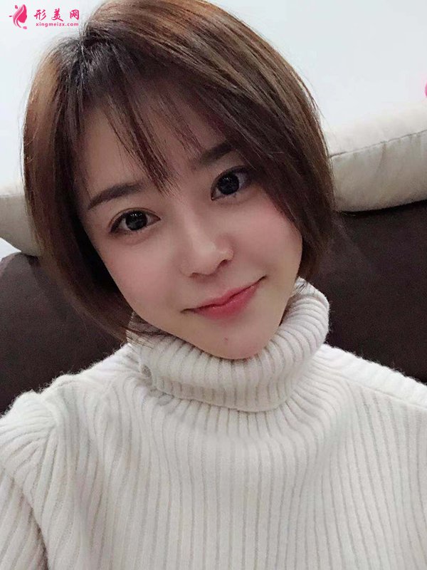 上海華美醫(yī)療美容醫(yī)院徐文龍醫(yī)生膨體隆鼻案例-整容案例 上海華美醫(yī)療美容醫(yī)院徐文龍醫(yī)生膨體隆鼻案例