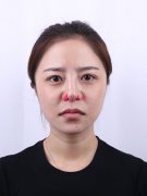 上海華美醫(yī)療美容醫(yī)院徐文龍醫(yī)生膨體隆鼻案例