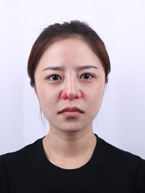 上海華美醫(yī)療美容醫(yī)院徐文龍醫(yī)生膨體隆鼻案例-整容案例 上海華美醫(yī)療美容醫(yī)院徐文龍醫(yī)生膨體隆鼻案例