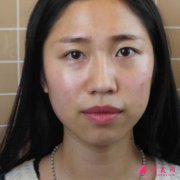 八大處于曉波雙眼皮做得怎么樣?看案例了解效果風格怎樣