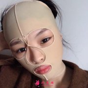 四川友誼醫(yī)院整形科顴骨內(nèi)推安全嗎？附上顴骨內(nèi)推案例效果圖