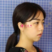 四川人民醫(yī)院東籬醫(yī)院怎么樣？看專家鼻綜合案例~反饋恢復(fù)效果圖