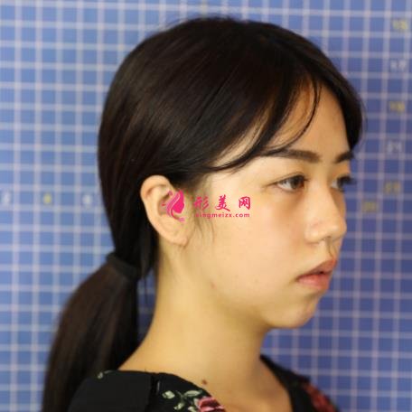 四川人民醫(yī)院東籬醫(yī)院怎么樣？看專家鼻綜合案例~反饋恢復(fù)效果圖