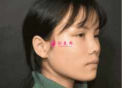 四川人民醫(yī)院東籬醫(yī)院三甲醫(yī)院嗎？附玻尿酸隆鼻效果及價格表