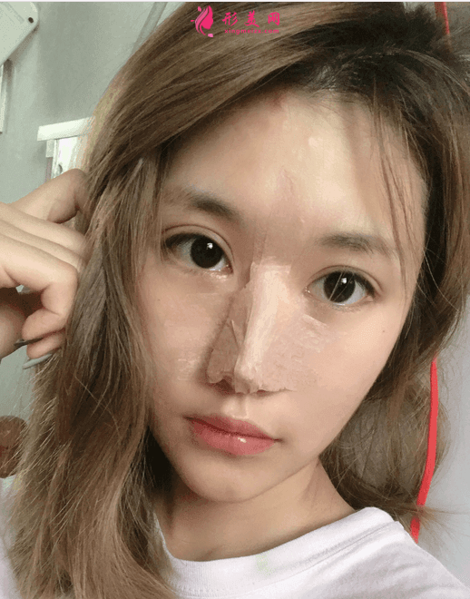 哈醫(yī)大四院美容科李巍隆鼻怎么樣？附隆鼻真人案例及2021價(jià)格表