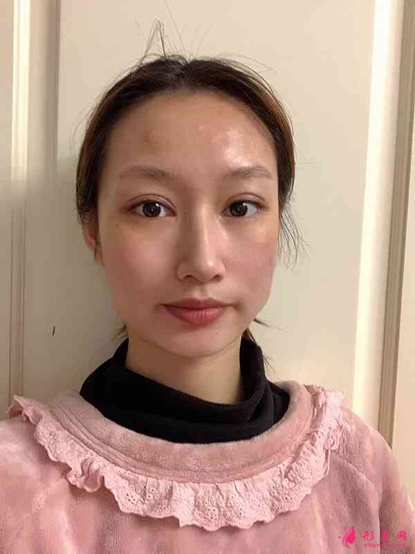 武漢五洲美萊整形怎么樣？2021價格表曝光+下頜角整形日記分享