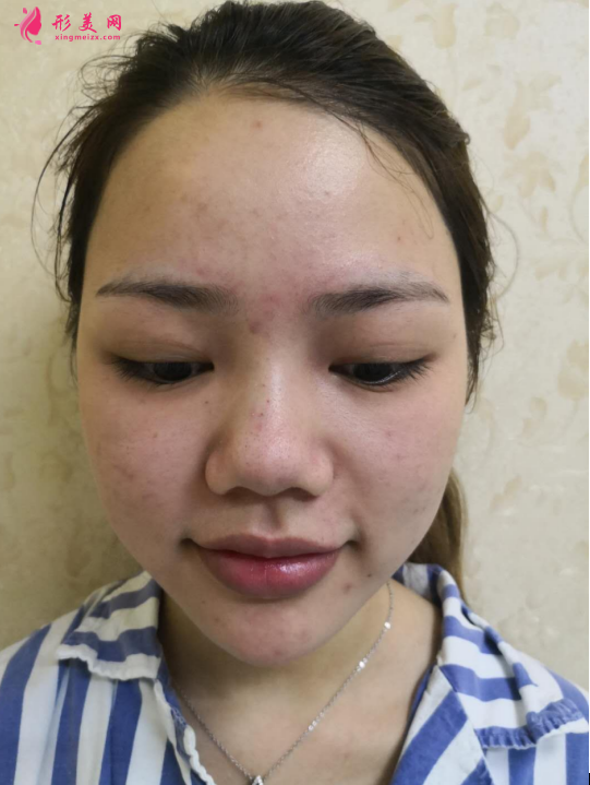 北京八大處隆鼻價格表一覽及隆鼻真人案例分享