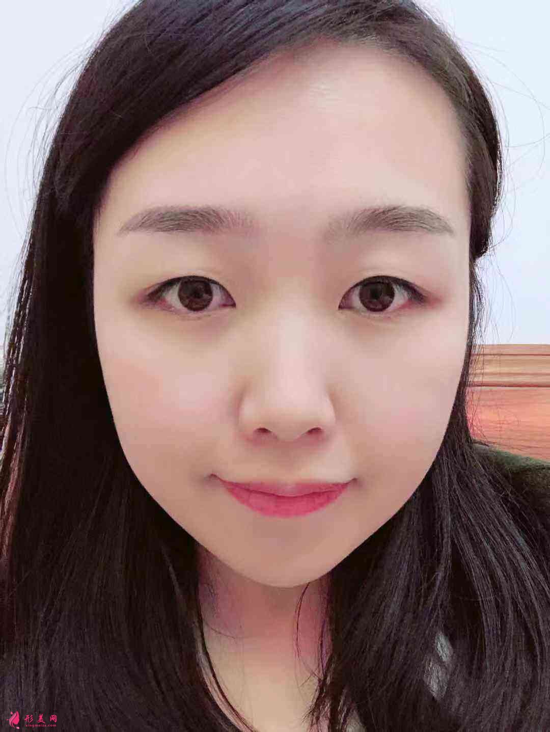 重慶星宸醫(yī)院雙眼皮怎么樣？術(shù)后三個(gè)月效果+2021價(jià)格表一覽
