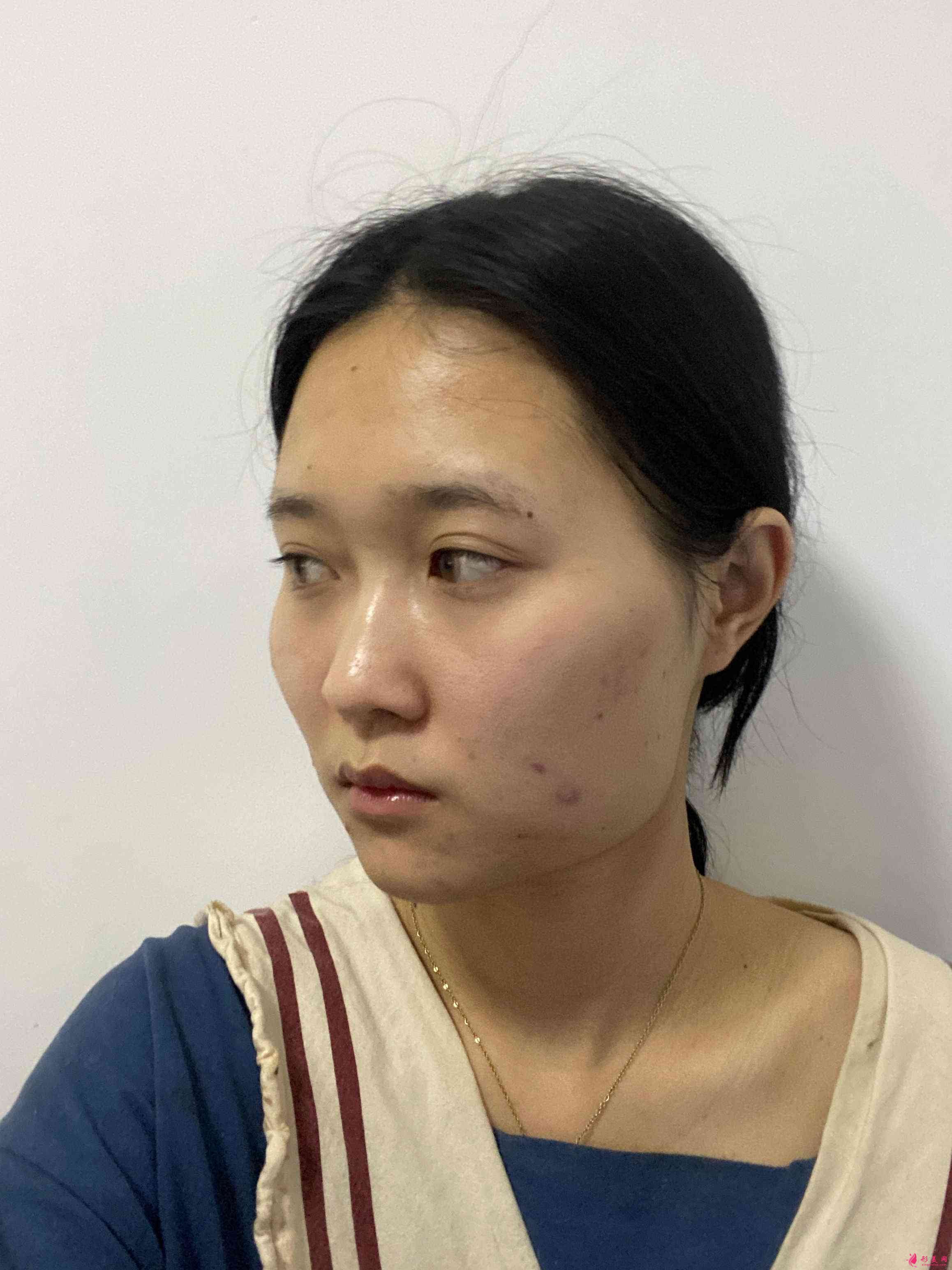 重慶當(dāng)代整形美容醫(yī)院怎樣?2021價(jià)格表發(fā)布+下頜角術(shù)后效果對(duì)比 重慶當(dāng)代整形美容醫(yī)院怎樣?2021價(jià)格表發(fā)布+下頜角術(shù)后效果對(duì)比
