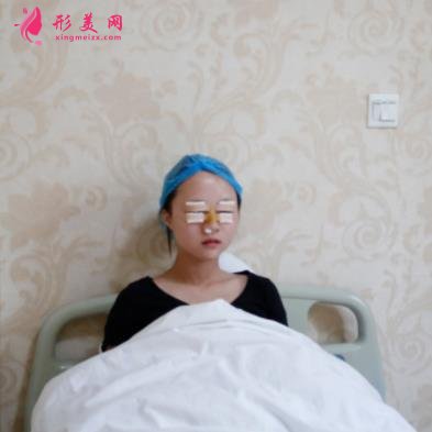 包頭一附院整形科怎么樣?雙眼皮案例實(shí)拍對(duì)比~術(shù)后效果很不一般
