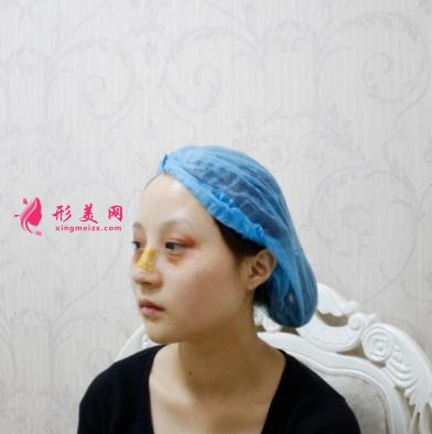 包頭一附院整形科怎么樣?雙眼皮案例實(shí)拍對(duì)比~術(shù)后效果很不一般