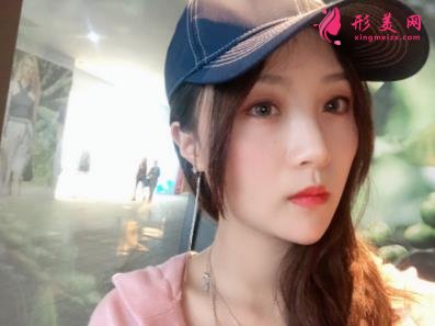 包頭一附院整形科怎么樣?雙眼皮案例實(shí)拍對(duì)比~術(shù)后效果很不一般