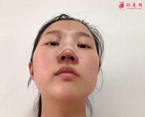 溫州藝星整形美容醫(yī)院做隆鼻怎么樣？好不好？專(zhuān)家案例價(jià)格收費(fèi)一覽