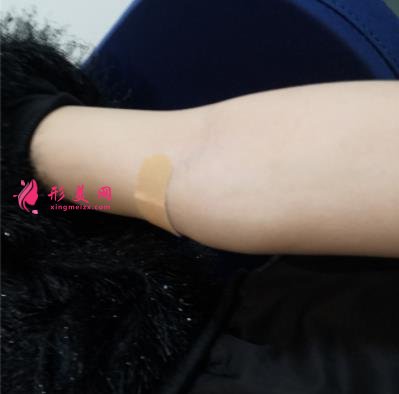河北工程大學(xué)附屬醫(yī)院整形外科手臂抽脂案例分享！含吸脂價(jià)格表公開