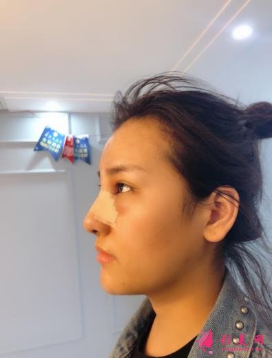 南京江寧鼻祖醫(yī)療美容靠譜嗎？做過來人告訴你這家做鼻子效果絕了~
