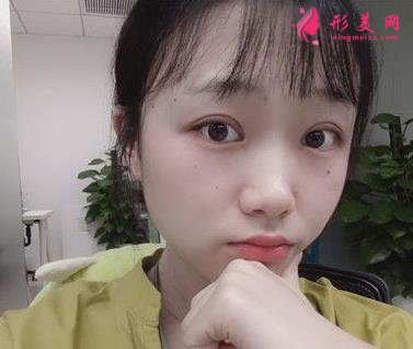 汕頭市中心醫(yī)院整形科價格收費詳情及做雙眼皮效果大揭秘