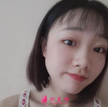 汕頭市中心醫(yī)院整形科價格收費詳情及做雙眼皮效果大揭秘
