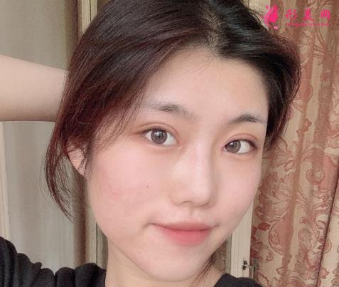 佛山市第一人民醫(yī)院美容科好嗎？雙眼皮案例及價格收費表公開對比
