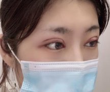 佛山市第一人民醫(yī)院美容科好嗎？雙眼皮案例及價(jià)格收費(fèi)表公開對(duì)比