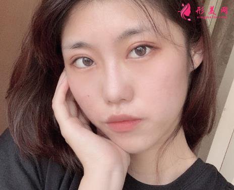 佛山市第一人民醫(yī)院美容科好嗎？雙眼皮案例及價格收費表公開對比