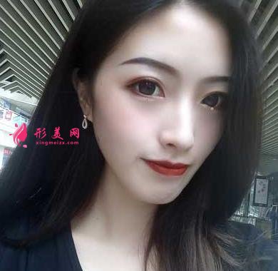 重醫(yī)附二院整形科怎么樣？快來參考埋線雙眼皮案例及價格價目表