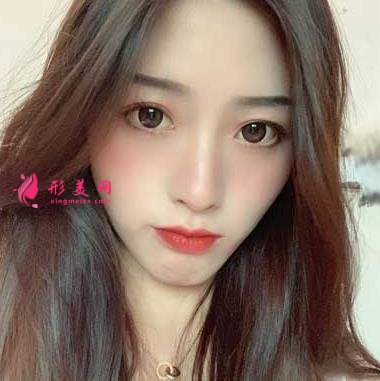 重醫(yī)附二院整形科怎么樣？快來參考埋線雙眼皮案例及價格價目表