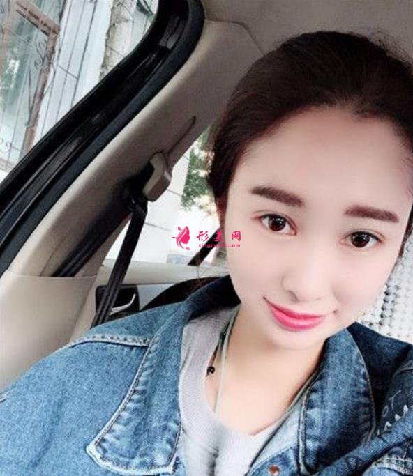 大連董萍醫(yī)療整形醫(yī)院埋線雙眼皮怎么樣？這里有術(shù)后寶典請收好