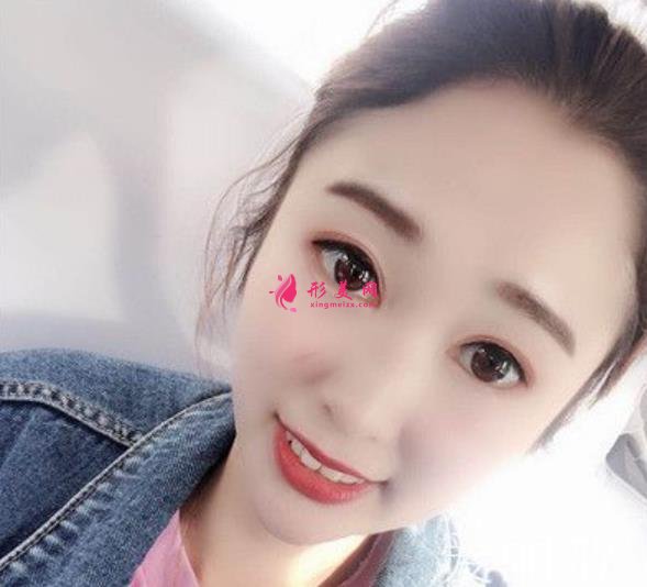 大連董萍醫(yī)療整形醫(yī)院埋線雙眼皮怎么樣？這里有術(shù)后寶典請收好