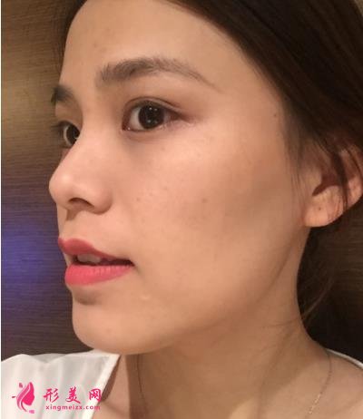 福州海峽美容醫(yī)院去眼袋怎么樣？技術(shù)特色、案例、價格收費雙雙公開