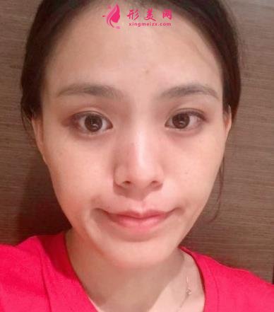 福州海峽美容醫(yī)院去眼袋怎么樣？技術(shù)特色、案例、價格收費雙雙公開